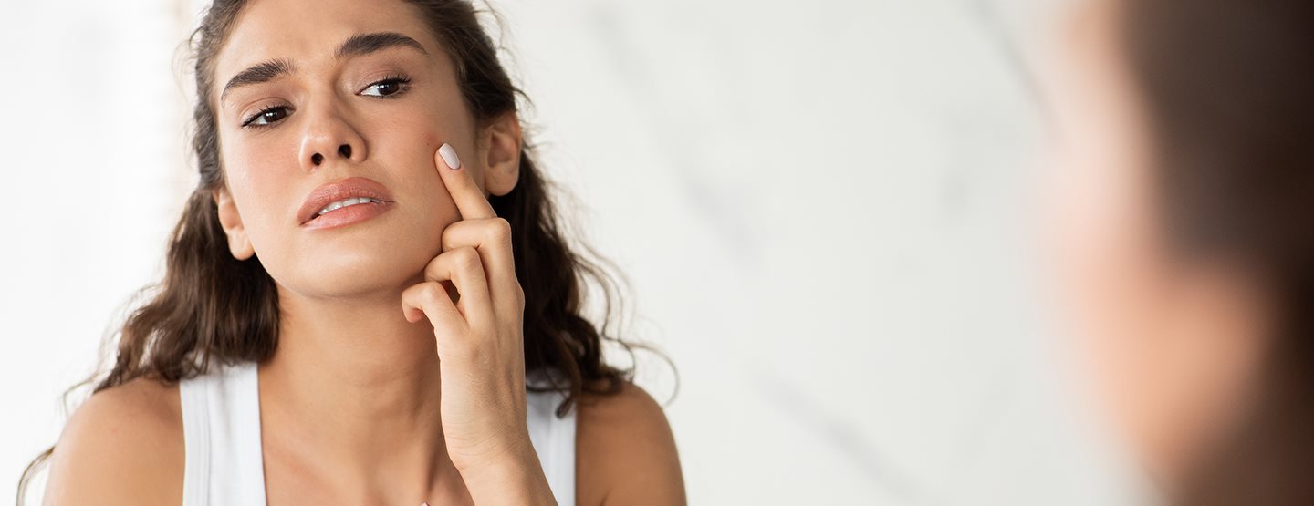 Hormonalne akne: dermatološkinja objašnjava šta može da pomogne