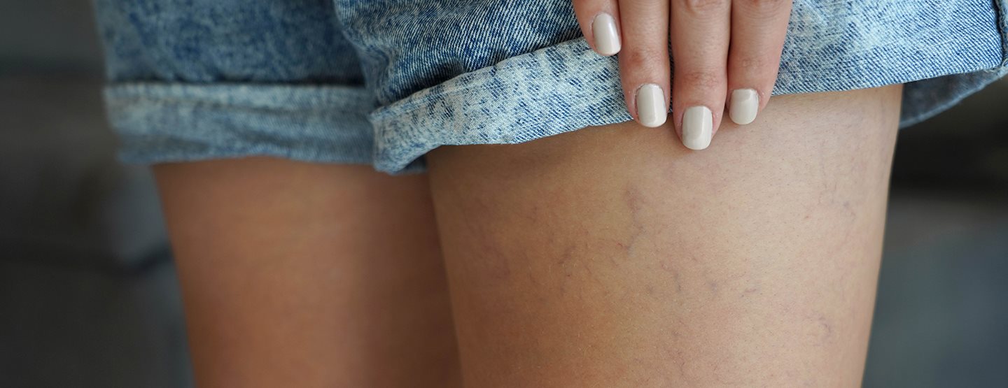Uklanjanje kapilara: dermatološkinja otkriva kako da to postignete!