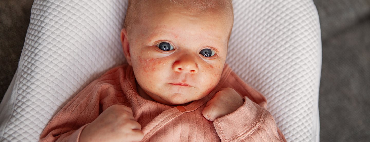 Akne kod beba: šta možete da preduzmete prema rečima dečje dermatološkinje